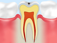C0（初期の虫歯）