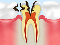 C3（神経まで侵された虫歯）