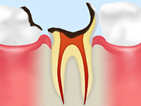 C4（末期の虫歯）