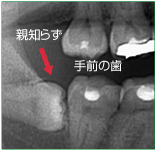 抜歯をおすすめしている例